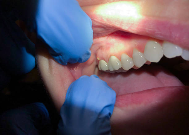 Best Urgent Care for Lost Fillings or Crowns in Chelsea, OK